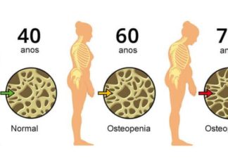 Osteoporose: Conheça melhor esta doença