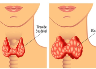 Conheça melhor as causas do Bócio